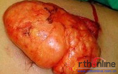 多发脂肪瘤表现为四肢,腰,腹部皮下等部位的多发结节,肿瘤的大小及