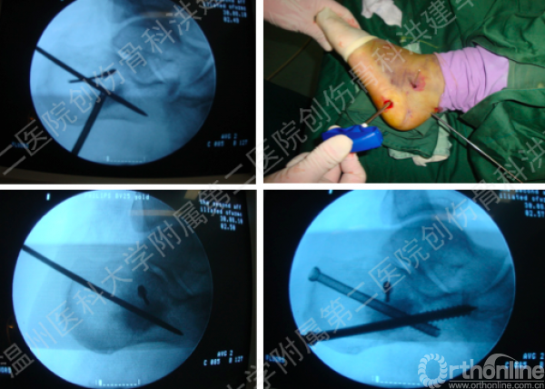 洪建军跟骨骨折经皮复位螺钉固定注射植骨手术技巧