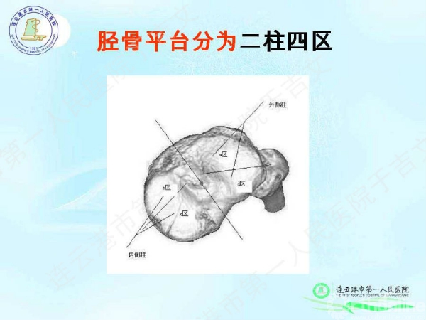 于吉文胫骨平台骨折mfb分型详解与应用