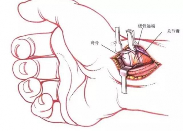 舟骨结节最高点,桡侧腕屈肌外缘;手舟骨掌侧入路不要切开关节囊,神经