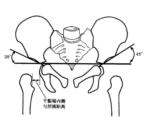 x线检查perkin方格连接两侧髋臼"y"形软骨作一水平线,再自髋臼顶外缘