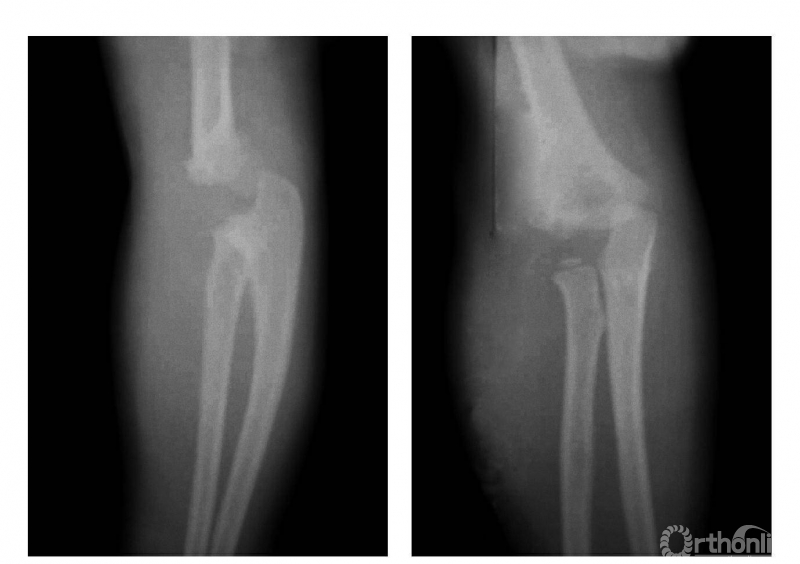 骨科常见疾病x线解析之肱骨远端全骨骺分离