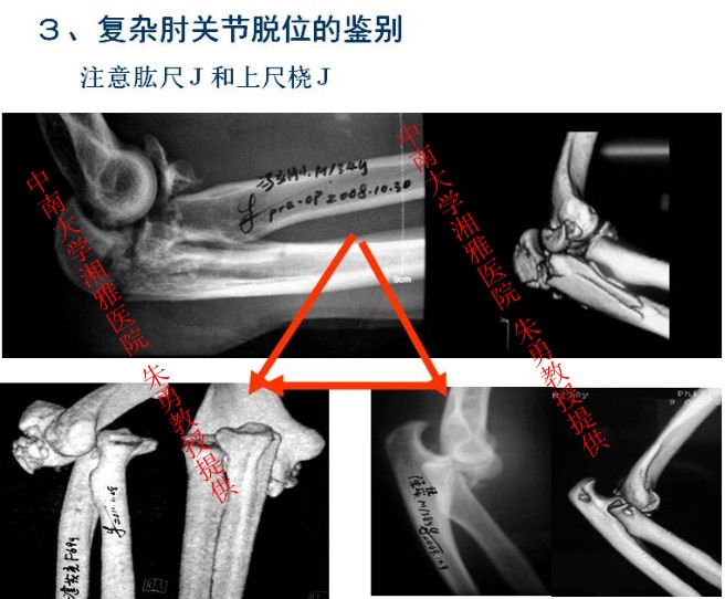 朱勇--复杂肘关节脱位的治疗