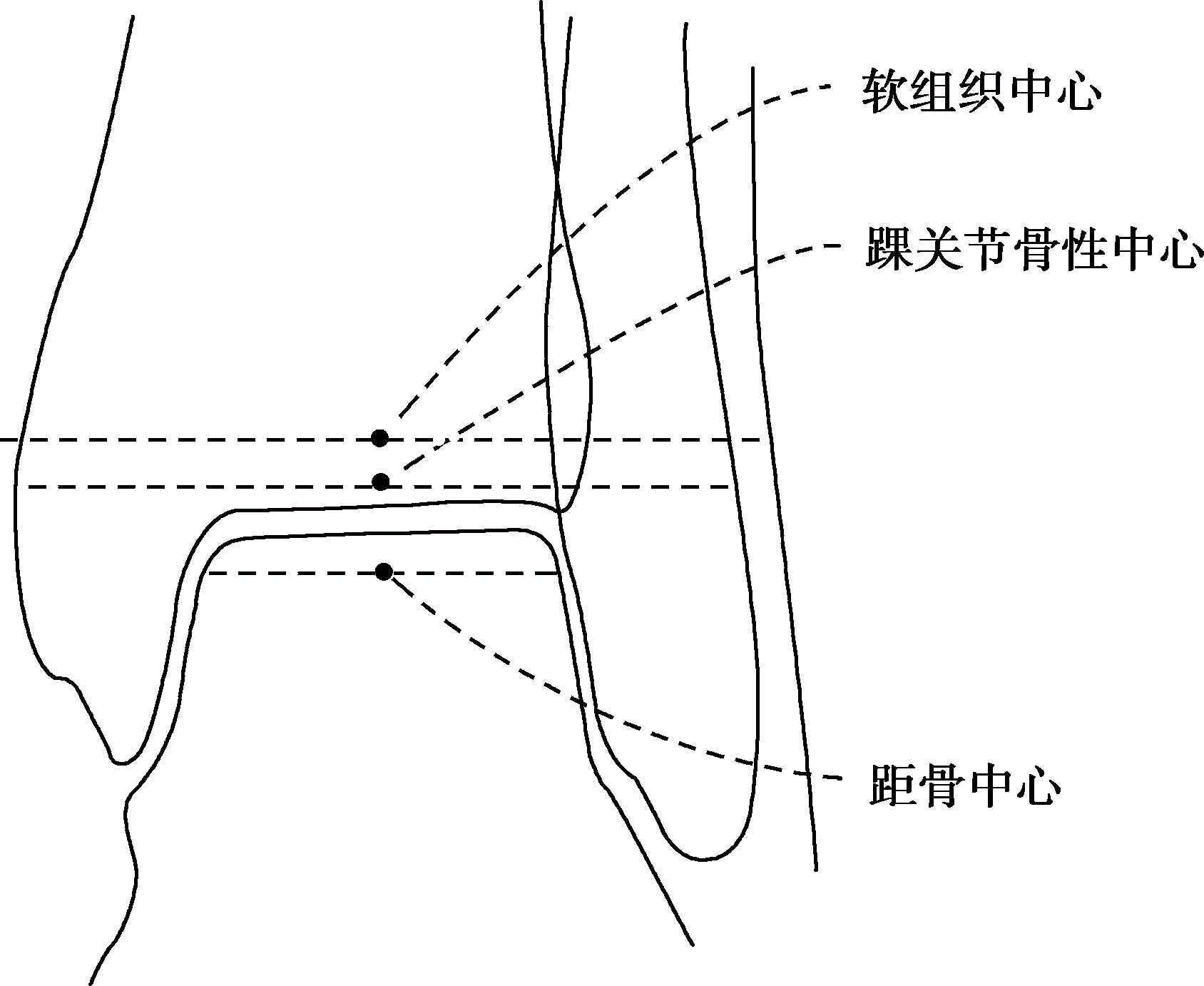 关节平面的软组织中心;②胫骨平台中心;③股骨髁中心;④胫骨棘突中心