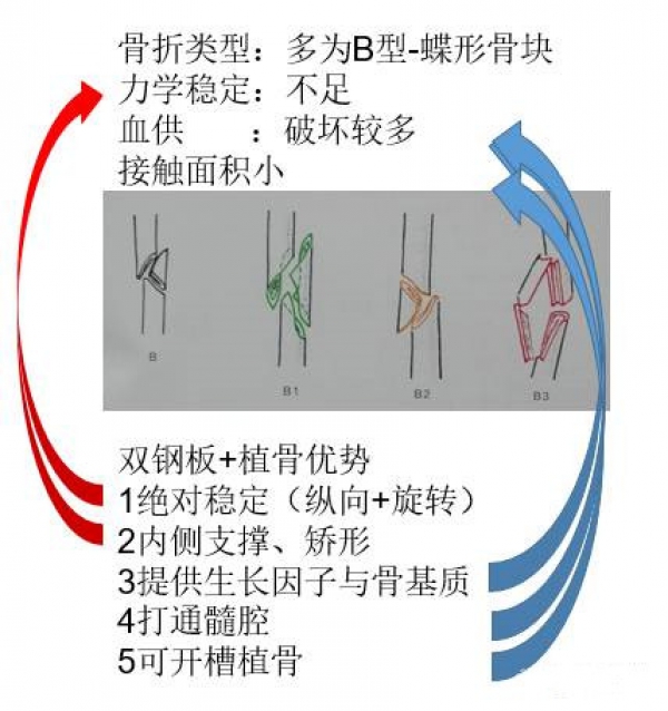 出现蝶形骨块后,往往蝶形骨块失去血运,如果单纯在外侧行内固定则容易