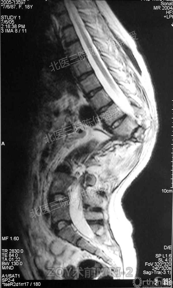 6ZQY术前MRI-2.jpg