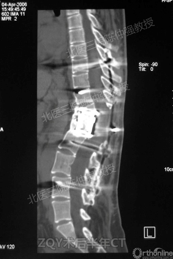 13ZQY术后半年CT.jpg