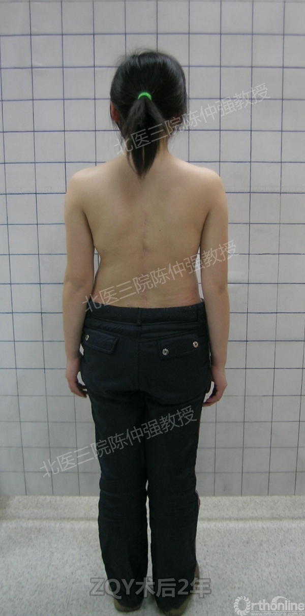 15ZQY术后2年.jpg