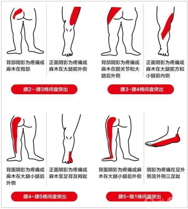 腰椎定位标志图片