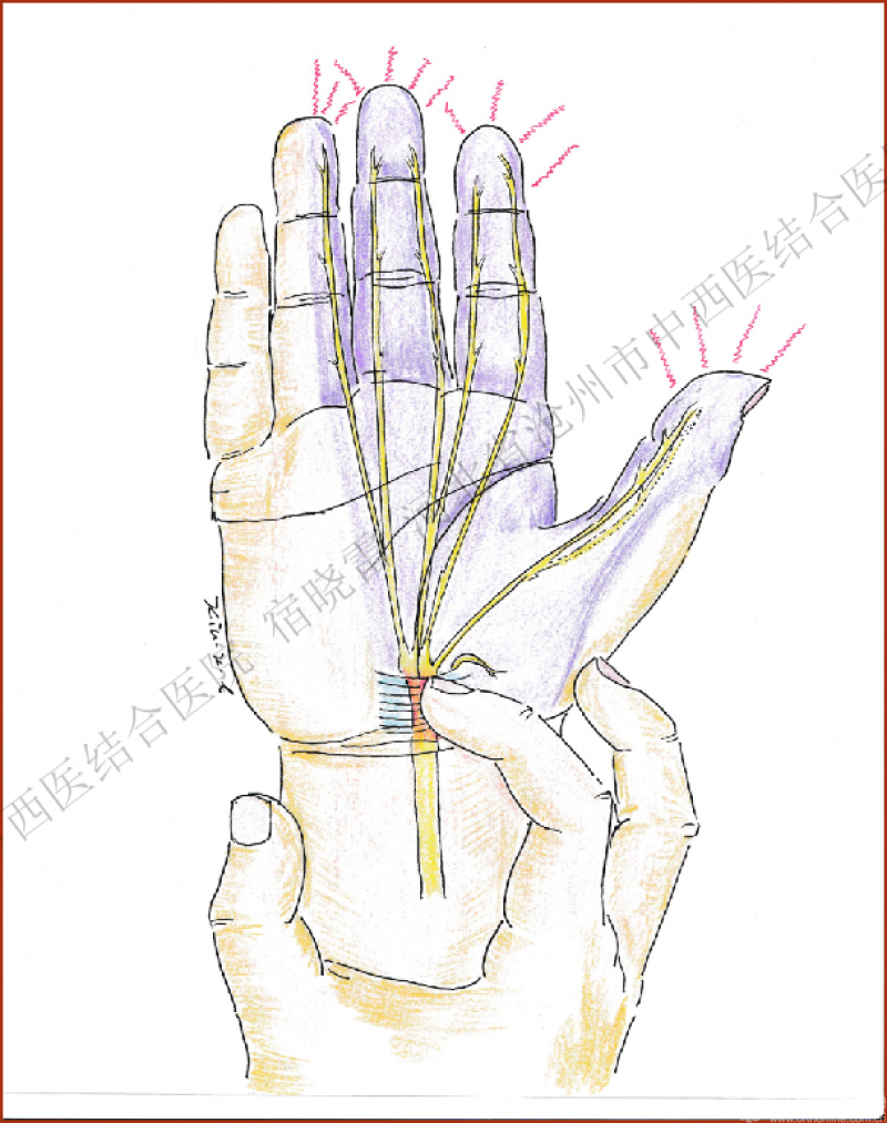 外固定:症状明显者,用石膏托或夹板固定腕部于轻度背伸位