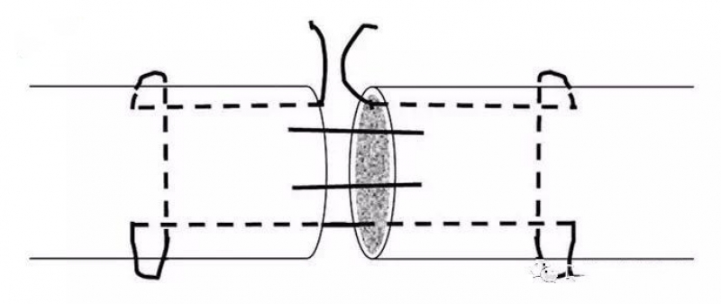 改良kessler缝合法krackow 缝合法
