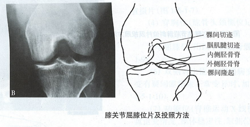 髁间窝图片