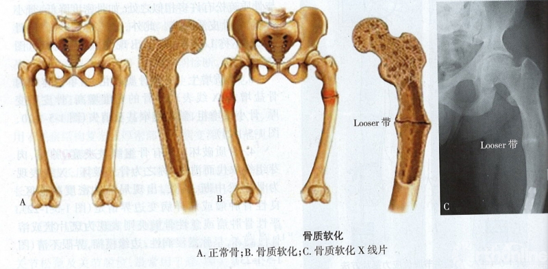 X片怎么看骨小梁图片