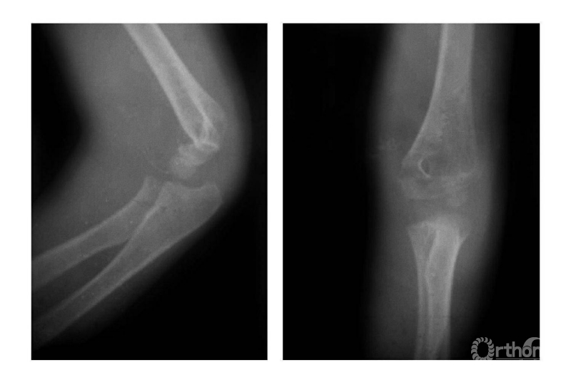 骨科常见疾病x线解析之肱骨远端全骨骺分离