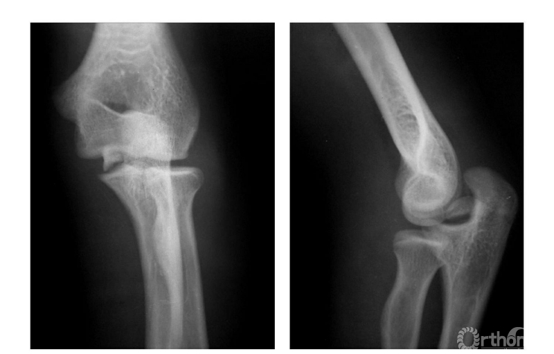 骨科常見疾病x線解析之肱骨內上髁骨折