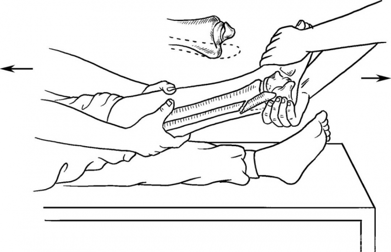 smith骨折手法复位图解图片