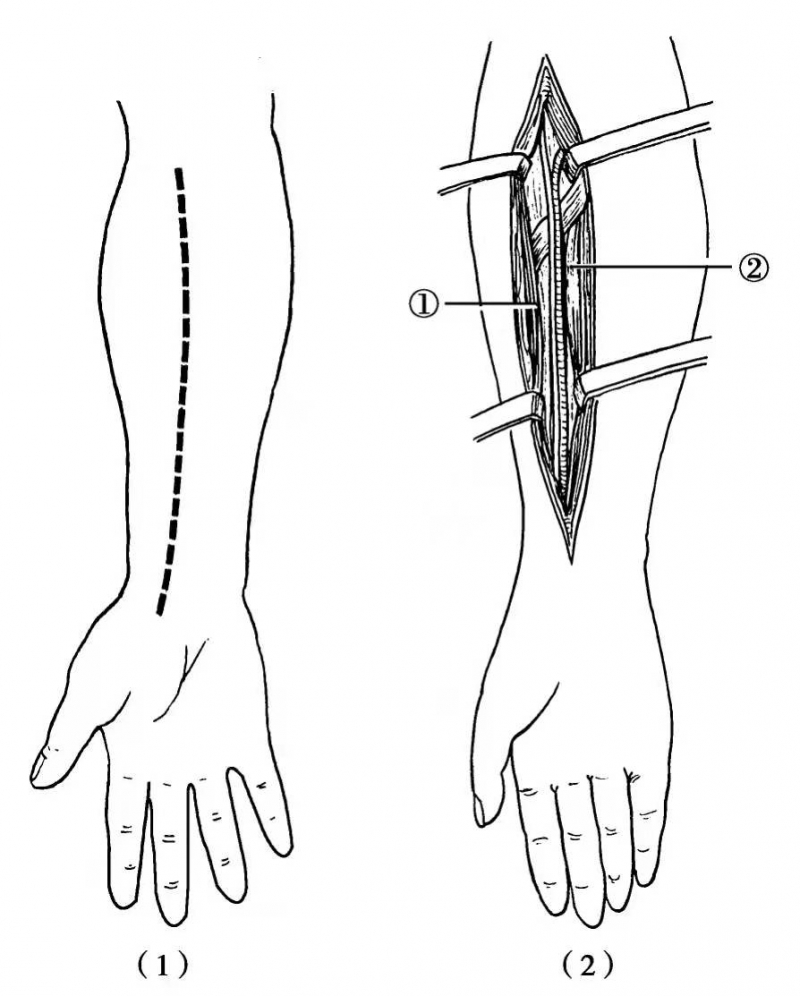 神经显露的手术切口及步骤之桡神经