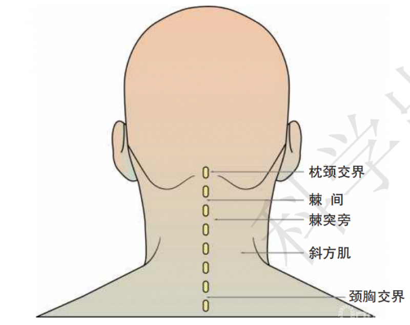 图1 颈项部常见的压痛点2.