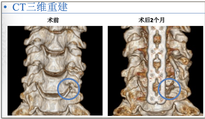 翼突钩增生图片