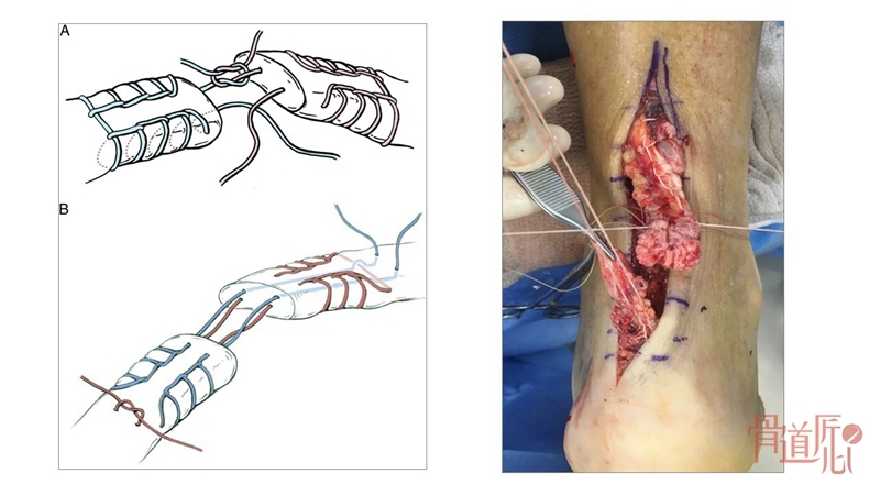 跟腱缝合方法图示图片