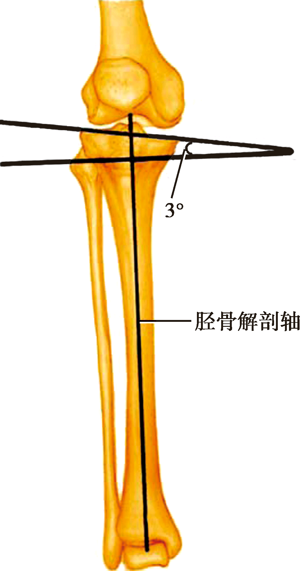 胫骨后倾角图片