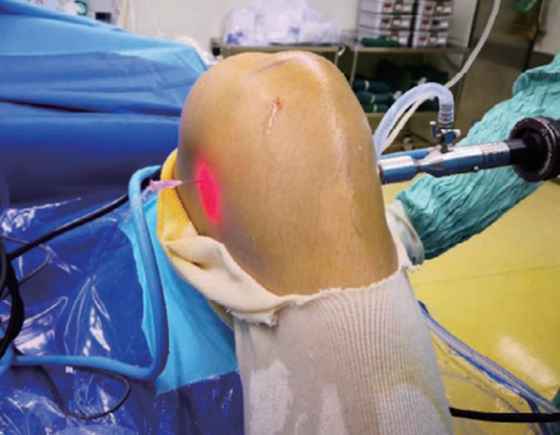 关节镜下后交叉韧带单束重建手术要点