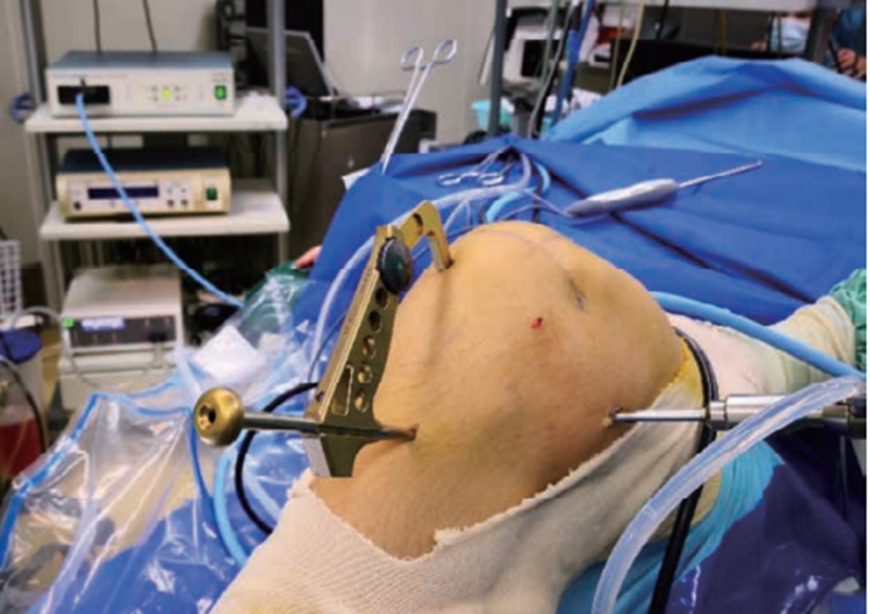 关节镜下后交叉韧带单束重建手术要点