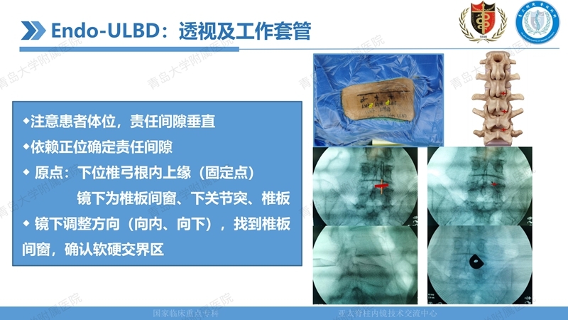 1. ULBD技术体系构建及临床应用 2023.4.5 - 15min_20.jpg