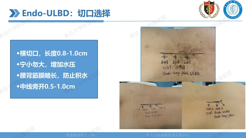 1. ULBD技术体系构建及临床应用 2023.4.5 - 15min_19.jpg