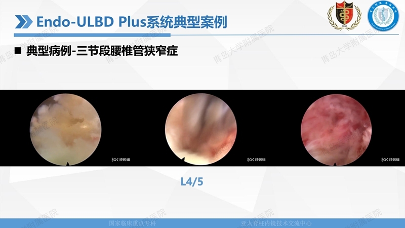 1. ULBD技术体系构建及临床应用 2023.4.5 - 15min_31.jpg