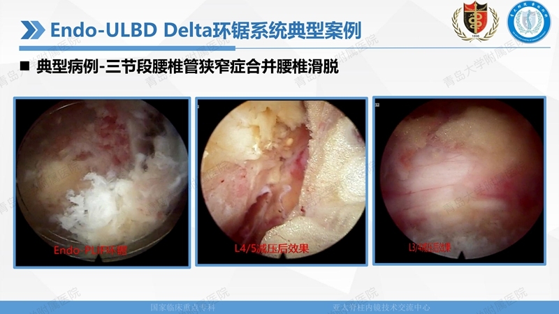 1. ULBD技术体系构建及临床应用 2023.4.5 - 15min_40.jpg