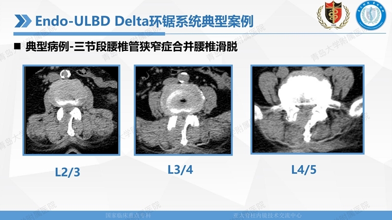 1. ULBD技术体系构建及临床应用 2023.4.5 - 15min_42.jpg