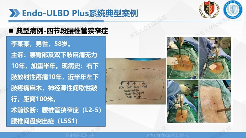 1. ULBD技术体系构建及临床应用 2023.4.5 - 15min_46.jpg