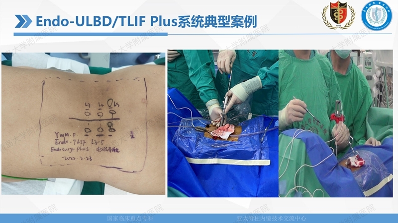 1. ULBD技术体系构建及临床应用 2023.4.5 - 15min_51.jpg