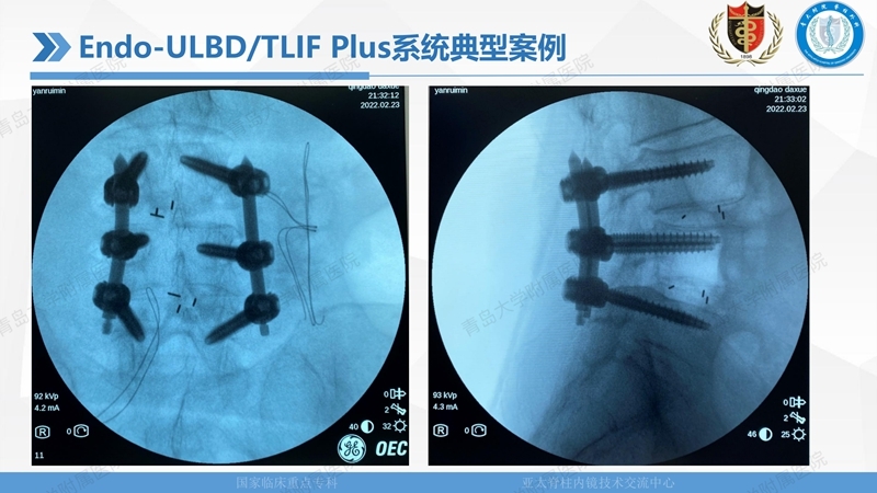 1. ULBD技术体系构建及临床应用 2023.4.5 - 15min_53.jpg