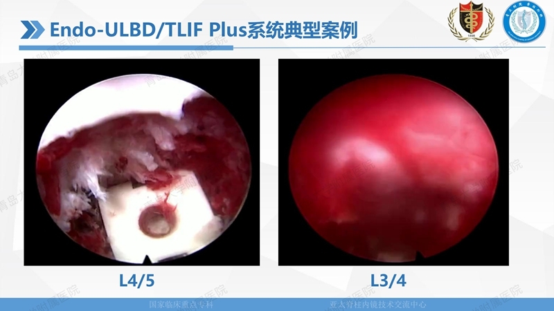1. ULBD技术体系构建及临床应用 2023.4.5 - 15min_52.jpg