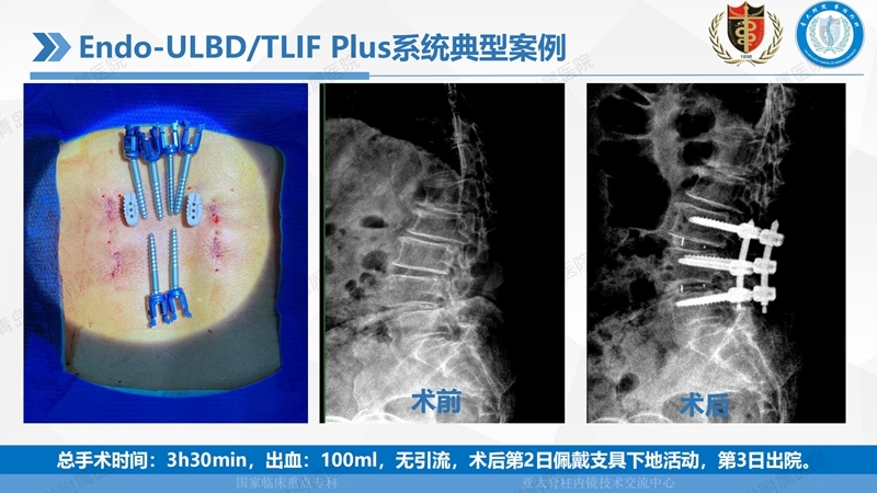 1. ULBD技术体系构建及临床应用 2023.4.5 - 15min_54.jpg