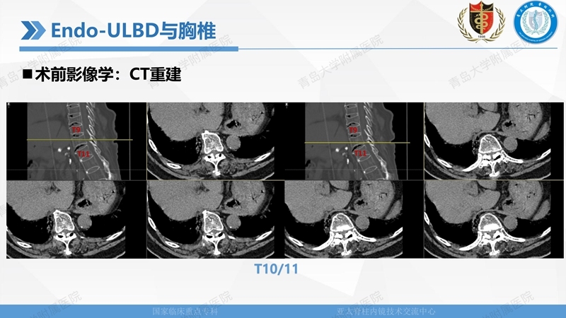 1. ULBD技术体系构建及临床应用 2023.4.5 - 15min_62.jpg