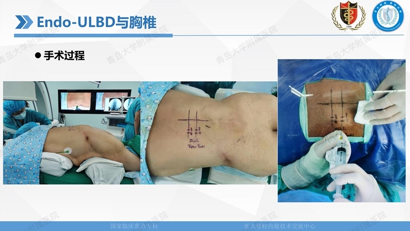 1. ULBD技术体系构建及临床应用 2023.4.5 - 15min_67.jpg