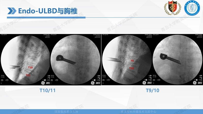 1. ULBD技术体系构建及临床应用 2023.4.5 - 15min_68.jpg