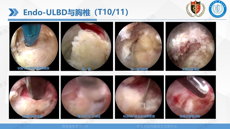 1. ULBD技术体系构建及临床应用 2023.4.5 - 15min_69.jpg