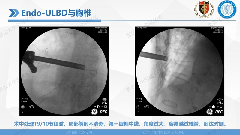 1. ULBD技术体系构建及临床应用 2023.4.5 - 15min_72.jpg