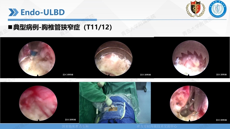 1. ULBD技术体系构建及临床应用 2023.4.5 - 15min_79.jpg