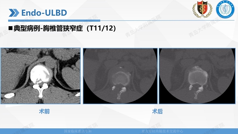 1. ULBD技术体系构建及临床应用 2023.4.5 - 15min_80.jpg
