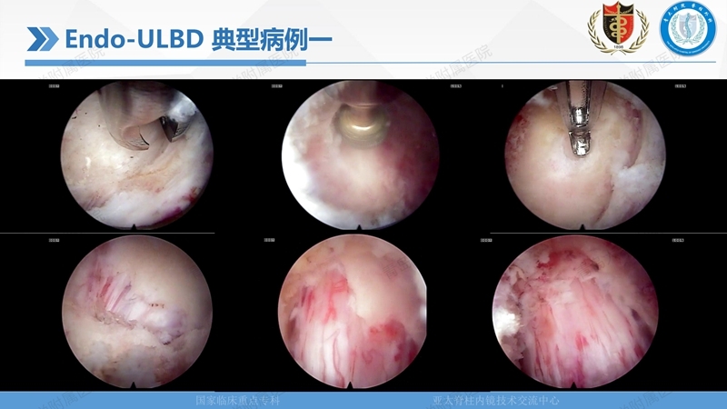1. ULBD技术体系构建及临床应用 2023.4.5 - 15min_95.jpg