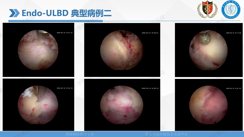1. ULBD技术体系构建及临床应用 2023.4.5 - 15min_102.jpg