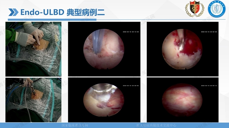 1. ULBD技术体系构建及临床应用 2023.4.5 - 15min_103.jpg