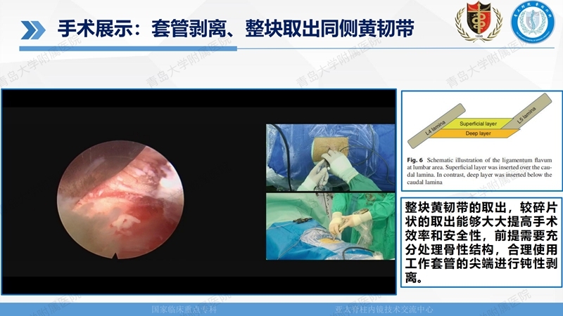 1. ULBD技术体系构建及临床应用 2023.4.5 - 15min_112.jpg