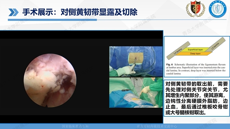 1. ULBD技术体系构建及临床应用 2023.4.5 - 15min_113.jpg