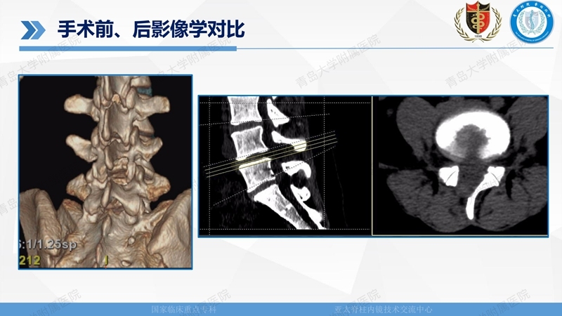1. ULBD技术体系构建及临床应用 2023.4.5 - 15min_117.jpg